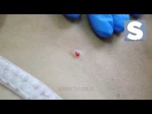 Удаление гемангиомы кожи
