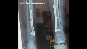 Лечение торсии костей голени. Деформация нижних конечностей.