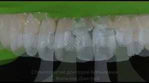 Лечение стираемости зубов. Реставрация зубов по силиконовому ключу. Front teeth restoration.