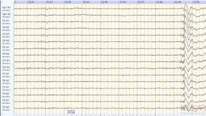 Приступ эпилепсии во время записи ЭЭГ