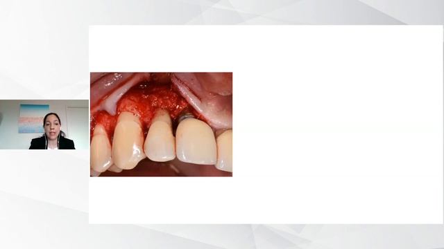 Бренда Мертенс, Франция - Периимплантит смотреть онлайн