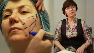 Подтяжка лица нитями (малоинвазивные методики омоложения лица)