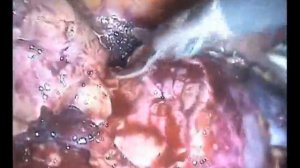 Лапароскопическая резекция почки при раке T1aN0M0