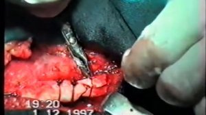 Закрытый многооскольчатый перелом ключицы