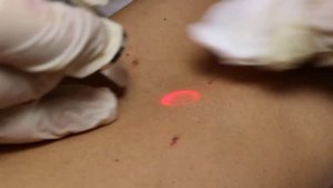 вишневая ангиома Cherry angioma