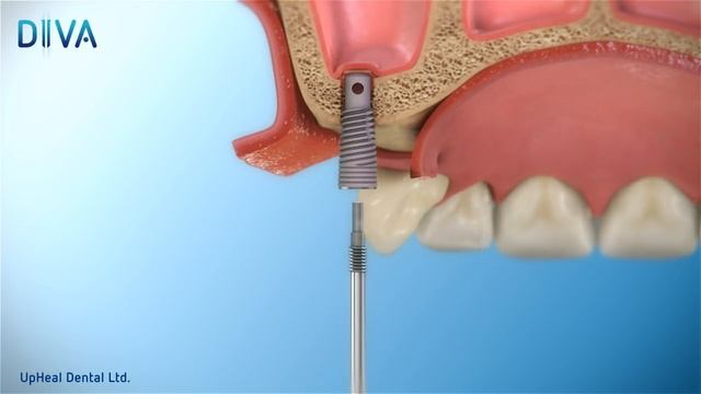 UpHeal Dental's amazing DIVA sinus lift technology 2016 смотреть онлайн
