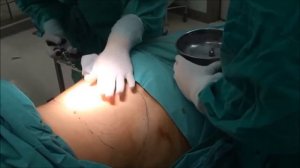 Процедура лазерного липолиза на QuadroStarPRO 980нм  от Asclepion