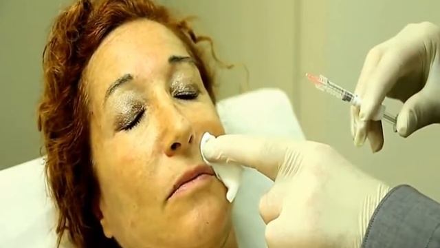 Инъекции Гиалуроновой Кислоты для удаления морщин