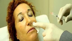 Инъекции Гиалуроновой Кислоты для удаления морщин