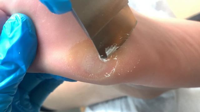 Callus removal from feet&Foot scraping dead skin【Xiao Yan pedicure】#stress 35 смотреть онлайн