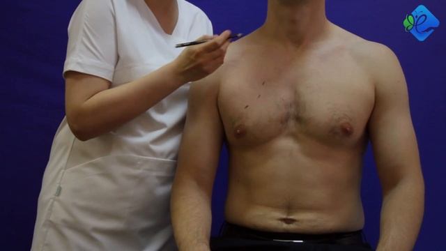 Отрыв большой грудной мышцы