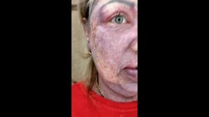 ЛЕЧЕНИЕ  РОДИМОГО ПЯТНА ЛАЗЕРОМ ,СЕНТЯБРЬ 2020(после лета)