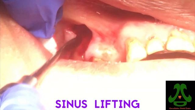 2 Important Tips in Open Sinus Lift Technique. смотреть онлайн