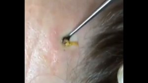 Подборка мерзостей,угри,прыщи,черные точки/A selection of abominations,blackheads,pimples,black dot