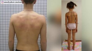 Диагностика сколиоза (как определить самостоятельно)