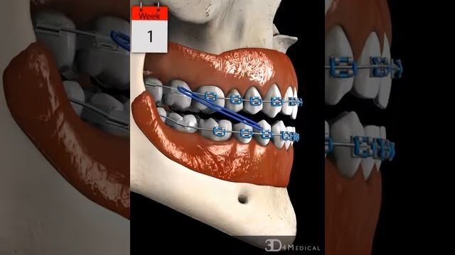 Braces: Anterior Crossbite (Class III)