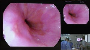 03Live Ткаченко ОБ Очаговая метаплазия нижней трети пищевода PENTAX 7010