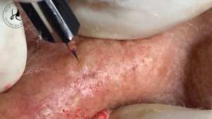 #256 | Huong Da Nang - Super Big Acne Part 1