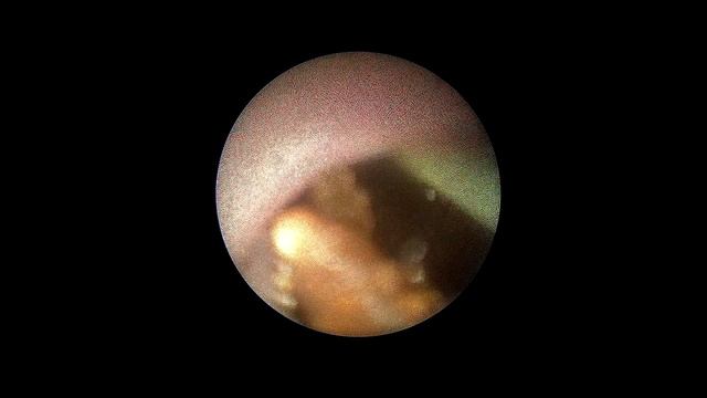 Ureteroscopy and laser lithotripsy / Лазерная уретеролитотрипсия