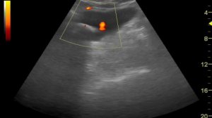 Artifact Twinkling  Камень в мочевом пузыре