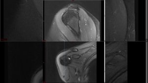 Shoulder MRI (Approach to MSK MRI Series)