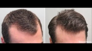 Результаты после применения миноксидила