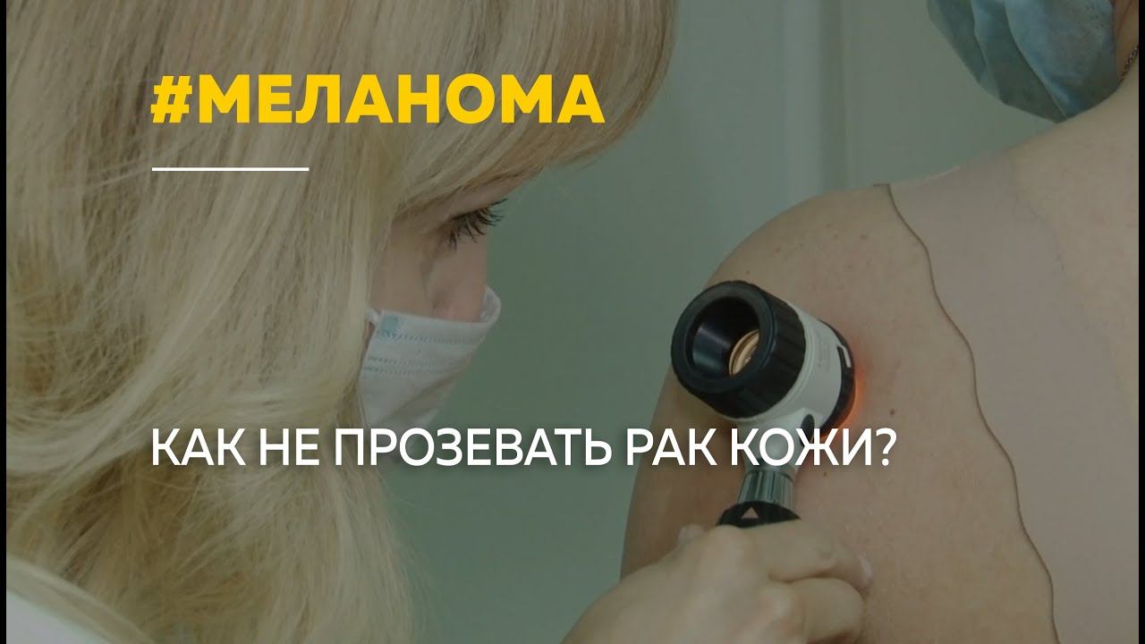 Меланома: как не прозевать рак кожи