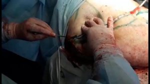 Abdominoplasty before and after.Абдоминопластика до и после.