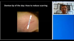 Botox Training - Reduce Scarring - (858) 905-5780
