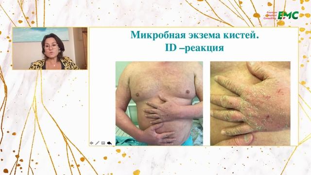 4. Экзема. Тактика ведения пациентов. Ольга Борисовна Тамразова