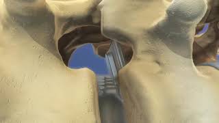 Установка межтелового фиксатора Баррикейд смотреть онлайн