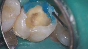 Лечение глубокого кариеса под микроскопом Carl Zeiss