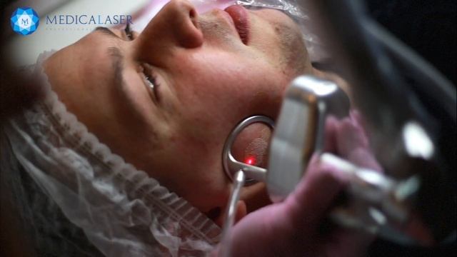 ШЛИФОВКА рубцов на лице! Обзор СО 2 лазера Medicalaser Pixel! смотреть онлайн
