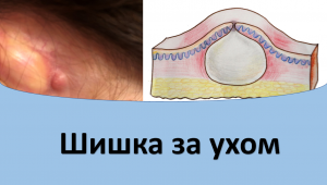 Шишка за ухом