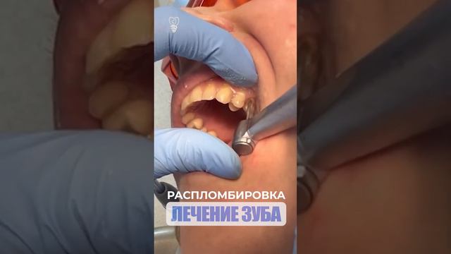 Лечение зуба. Распломбировка. Tooth treatment. Sealing.