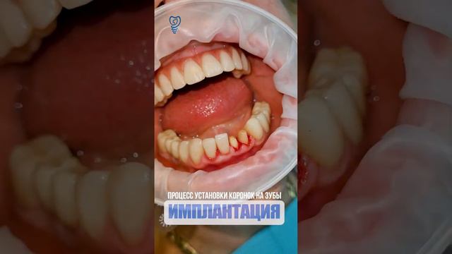 The process of installing crowns on teeth. #имплантация #dentist