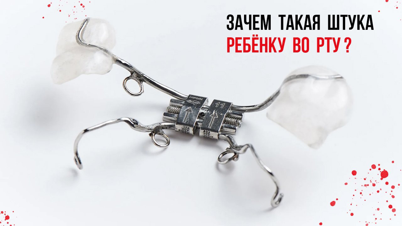 Расширение верхней челюсти у ребёнка [что очень важно знать‼️]