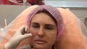 Коррекция скул филером в клинике Аура