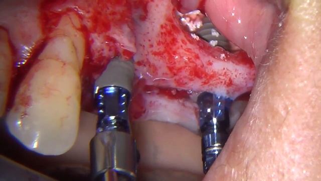 sinus lift lateral approach смотреть онлайн