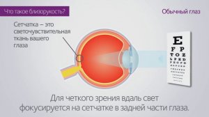 Что такое миопия