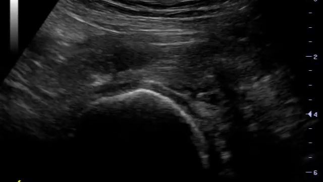 Болезнь тазобедренного сустава смотреть онлайн