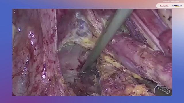Тотальная мезоректумэктомия - две трансляции, Лапино- Расулов, ККМХ - Царьков от 09.06.2022