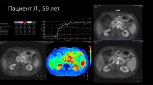 МР перфузия с радиальным сбором данных в сложных исследованиях поджелудочной железы - Тония Г.Т.