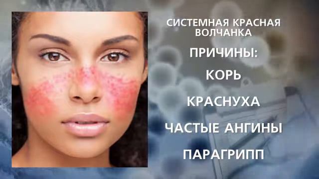 Системная красная волчанка