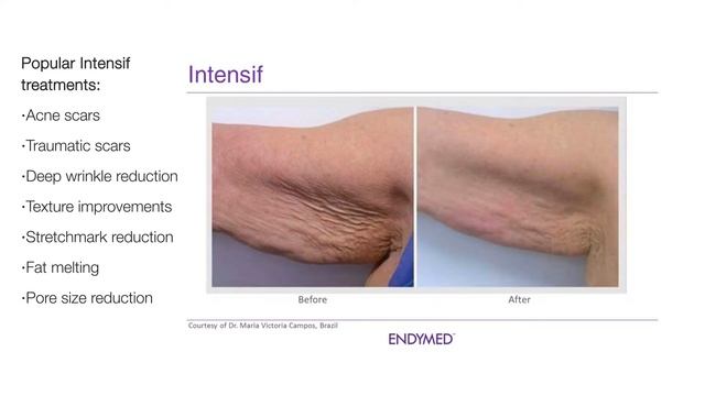 EndyMed Intensif RF Microneedle technology смотреть онлайн