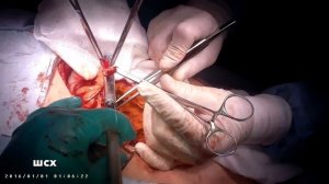 Несформированный кишечный свищ