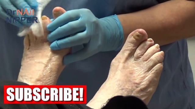 Toenails and a Fractured Foot.  Watch Until the End. 2021