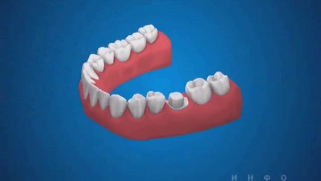 Слепки и одиночные коронки смотреть онлайн