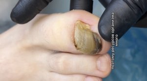 Онихогрифозные ногти