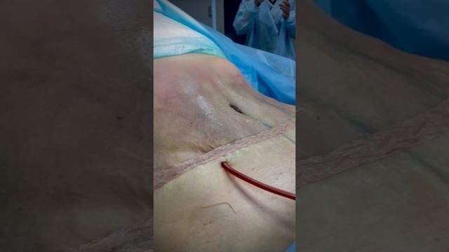 Липосакция + абдоминопластика с ушиванием диастаза / ДО - ПОСЛЕ / пластическая хирургия